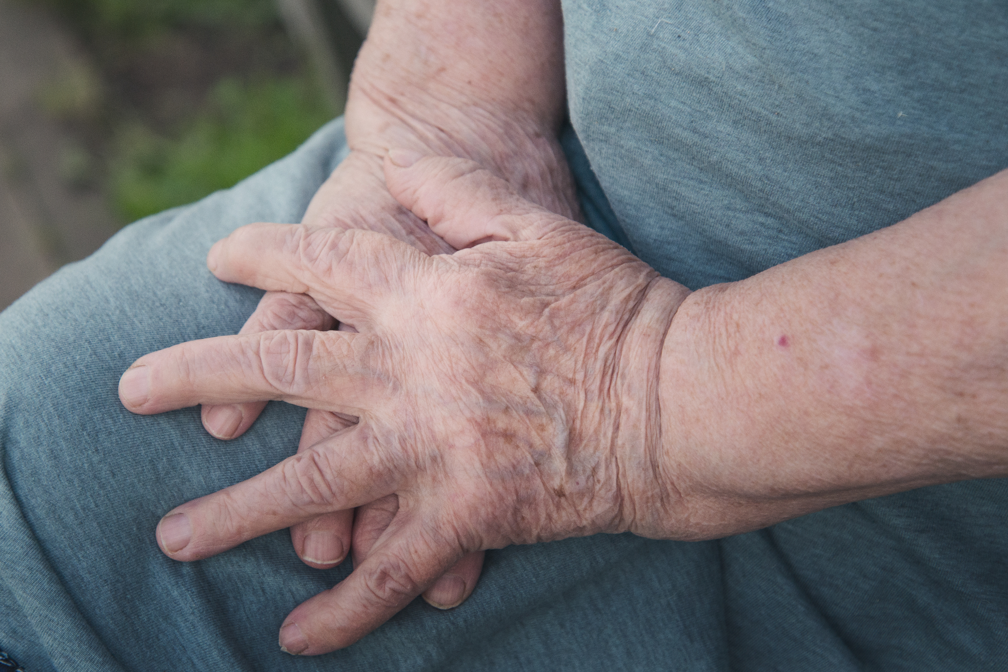 Revmatoidni artritis je nekaj kar se načeloma ne opazi